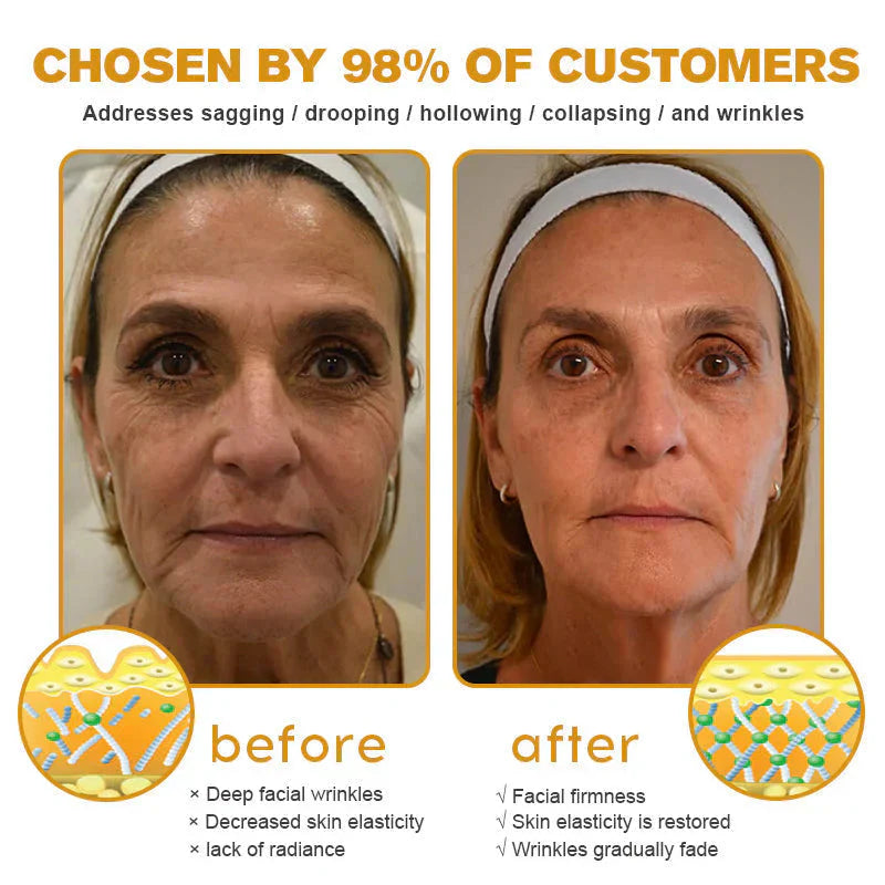 Botox Bee Venom Wrinkle Removal Cream Get Free Home Delivery